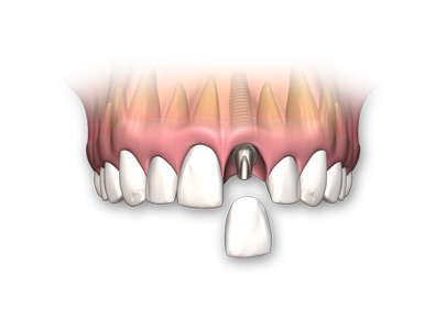Miami Dental Implants